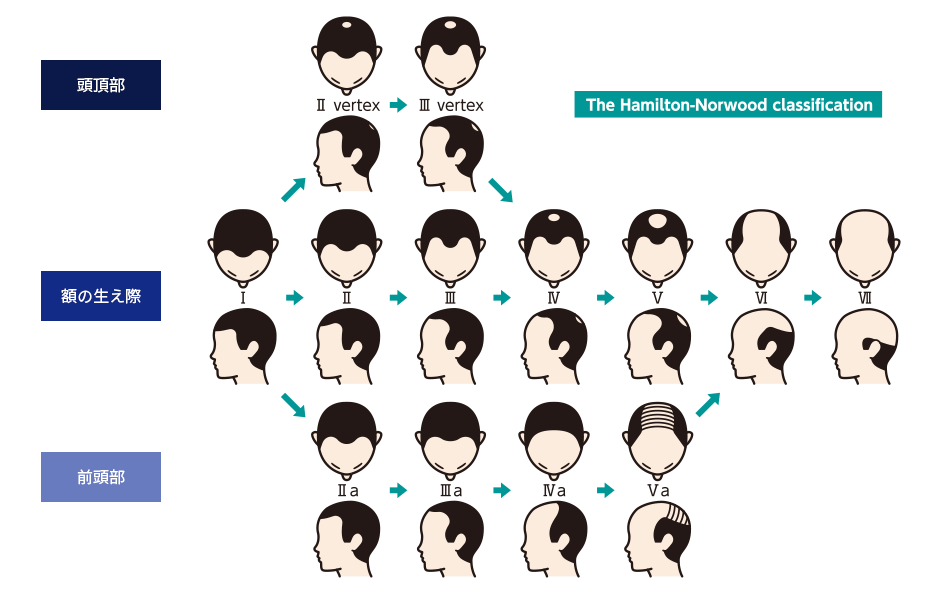 AGAの進行の段階 判断指標 ハミルトン・ノーウッド分類
